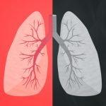 Feingold Medical Legal - Lung Cancer Risk for Non-Smokers