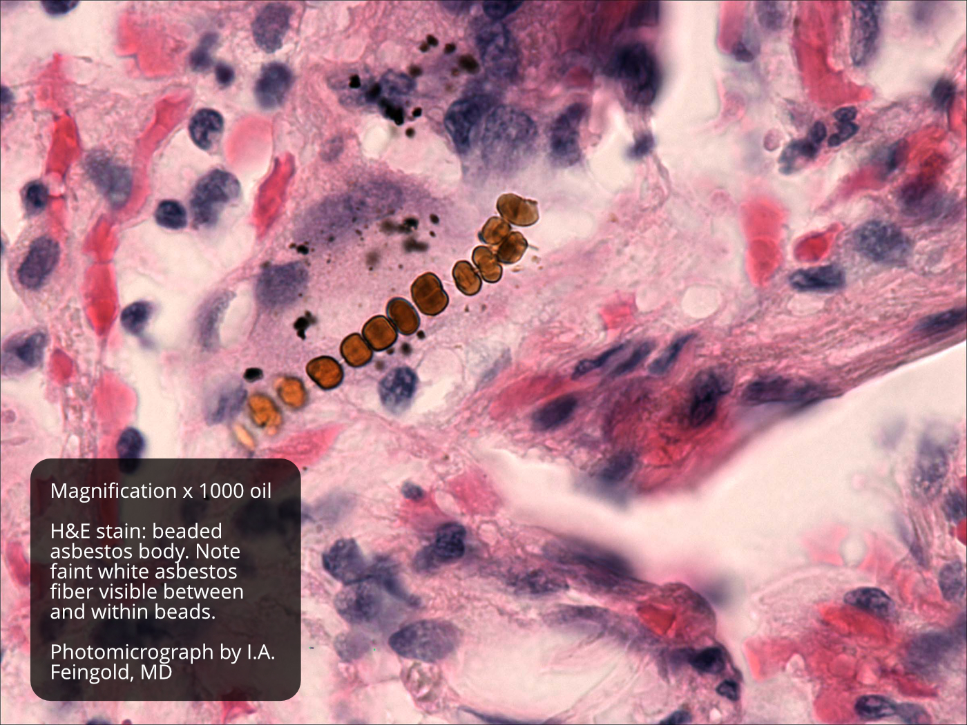 Feingold Medical Legal - Asbestos photomicrograph by Dr. Allan Feingold